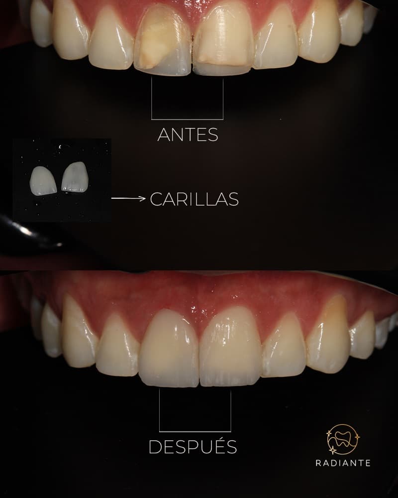 Antes y después de carillas en cerámica