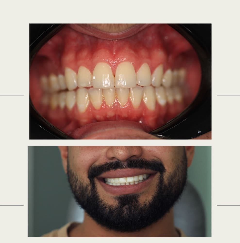 Antes y después de diseño de sonrisa